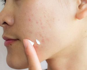 What are the very basic home remedies that you should follow for Face spot removal?
