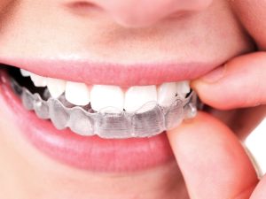 Smile with Confidence with Invisible Braces