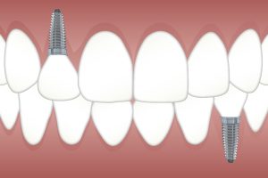 teeth-3597679_1280