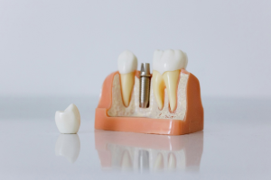 Dental Implants: A Concise Guide for Pre-Implant procedures