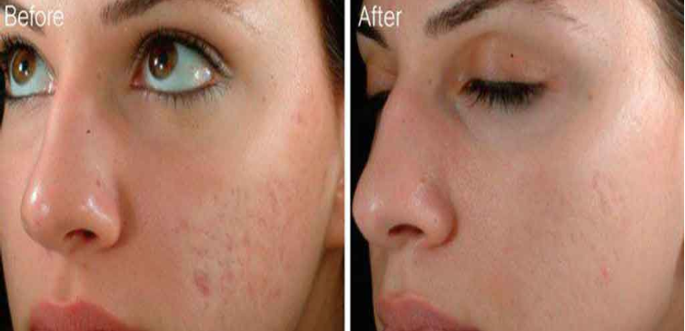 Microneedling Services in Toronto