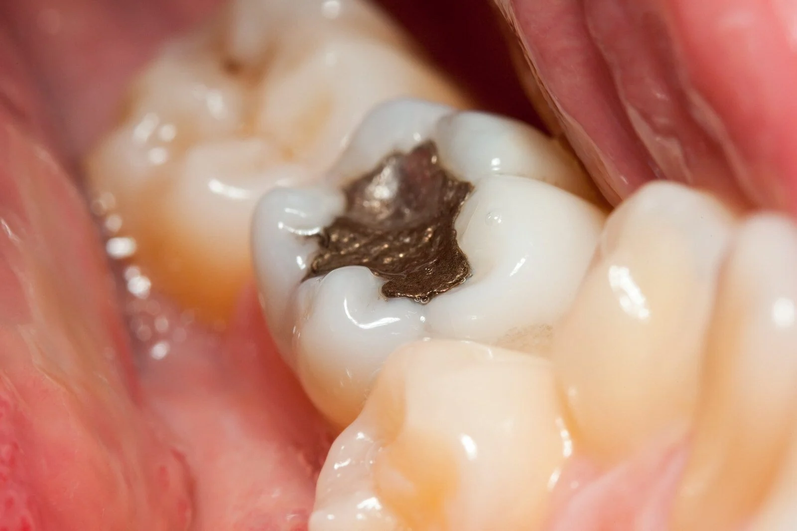 3 Secrets To Longer‑Lasting Dental Fillings