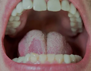 Oral Infections