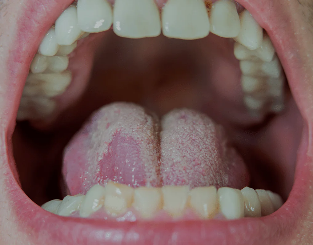 Oral Infections