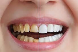 Why Fluoride Treatments Protect Against Generational Cavity Risks